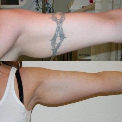 Tattoo Removal 201